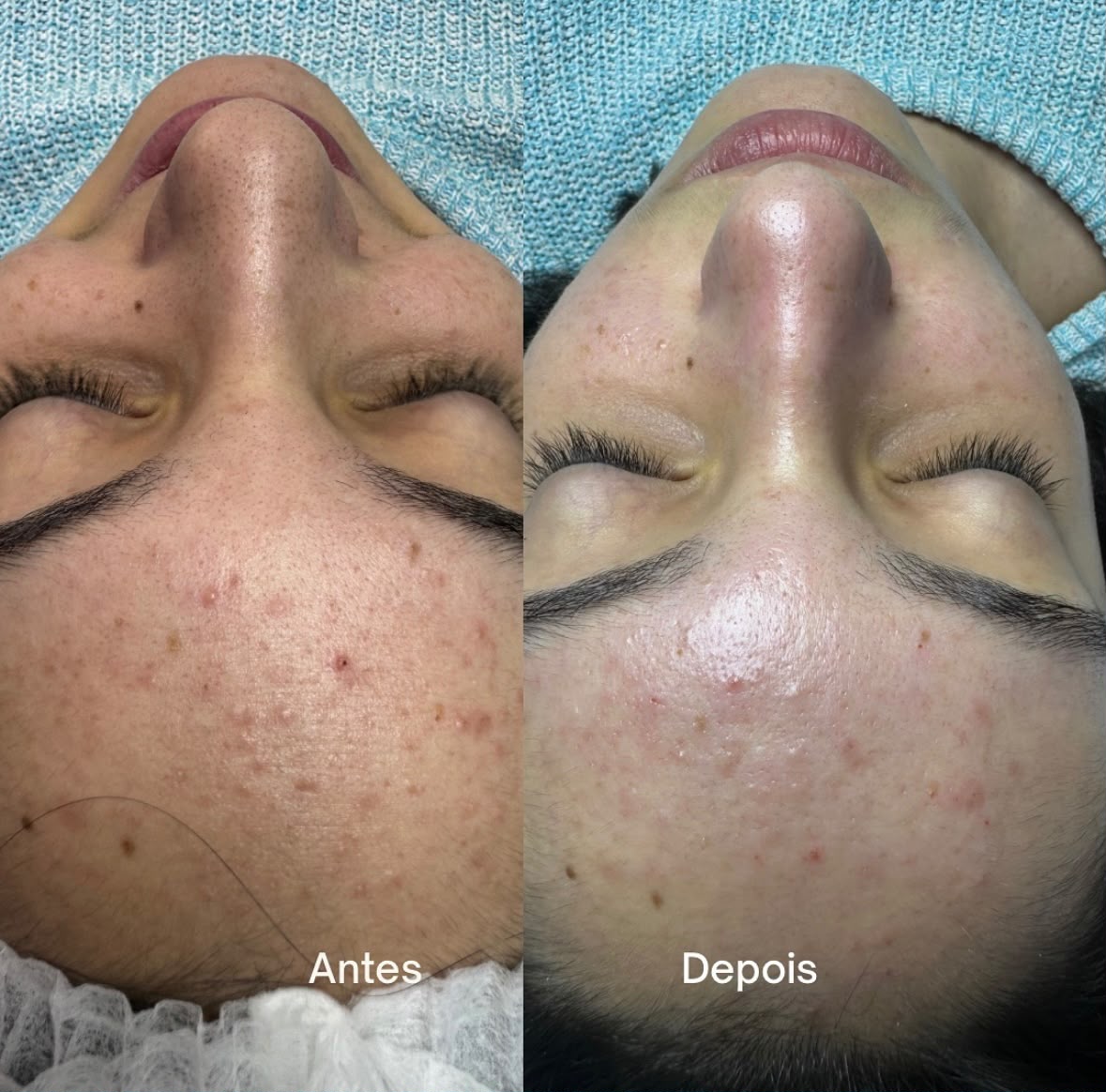 Antes e depois de tratamento facial